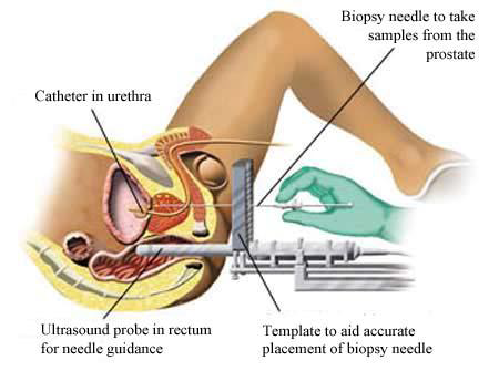 Transperineal_Biopsy.jpeg